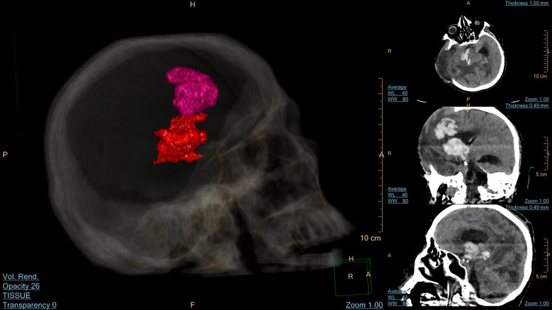 ct后处理重建技术,ct后处理技巧