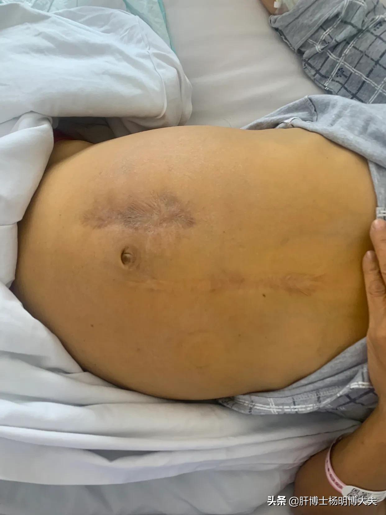 中药治乙肝有效吗,乙肝喝中药能转阴的案例