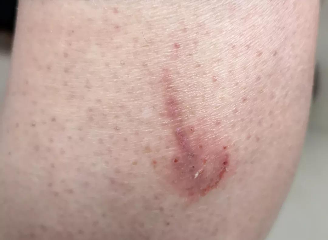 色素性紫癜性皮肤病是啥,色素性紫癜性皮肤病是什么