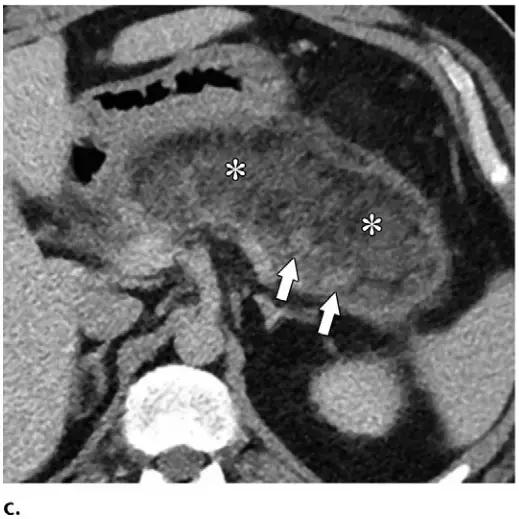 急性胰腺炎影像检查首选,急性坏死胰腺炎影像