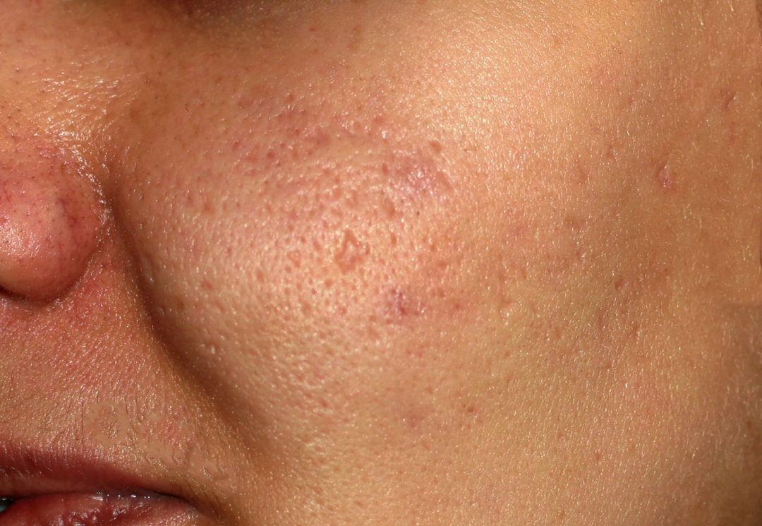 皮肤激光美容后如何护理,激光术后皮肤护理攻略