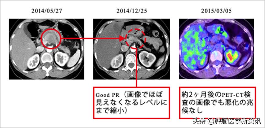 全世界治疗癌症的药物,日本癌细胞免疫疗法