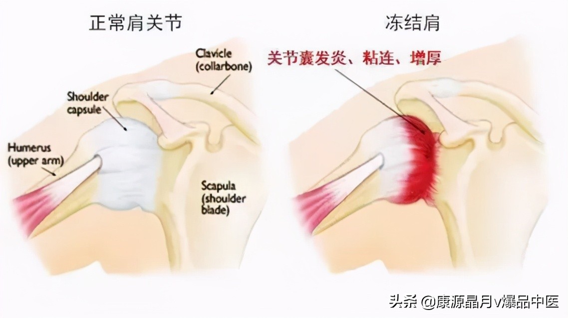 冻结肩一招解决,冻结肩怎么调
