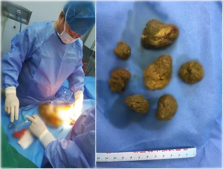 山楂能导致胃结石吗,空腹吃了山楂胀气怎么办