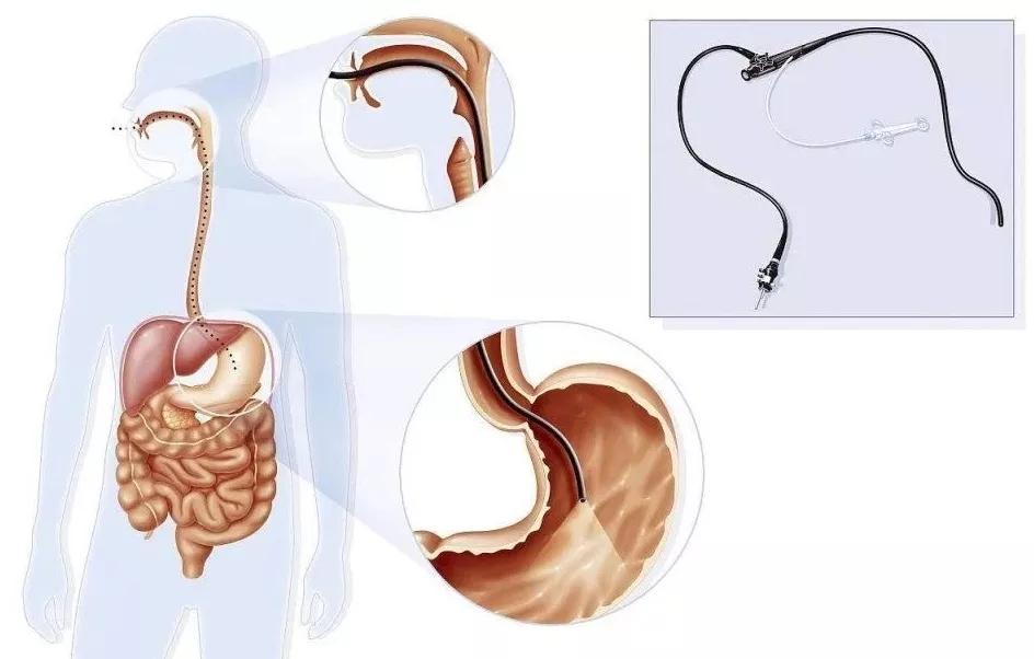 普通胃镜和无痛胃镜检查全过程,图说胃镜检查全过程