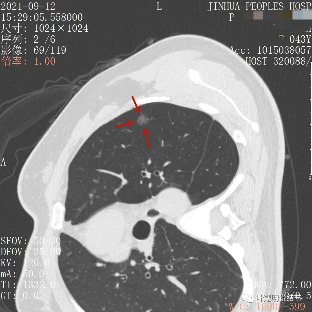 从活检怎么看是非小细胞癌,从病例谈辨证论治
