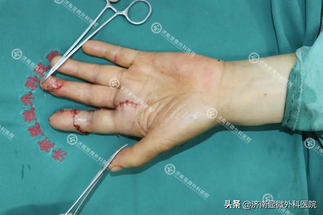 日本手指缺失修复,多年前断手指修复