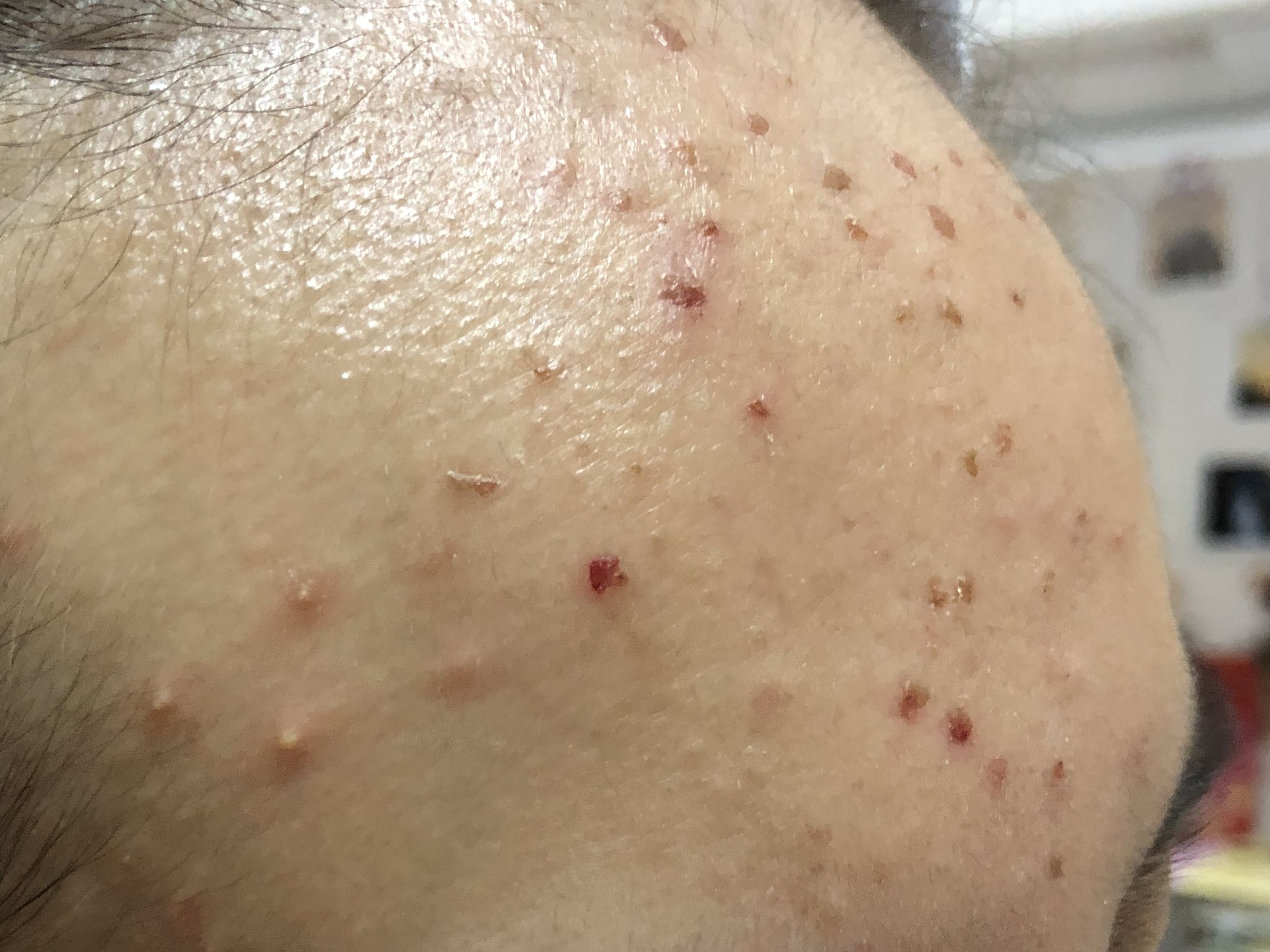 17岁女儿脸上长满痘痘，看了这篇文章才知道如何帮助她