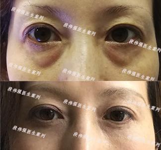 如何消除眼袋,如何消除眼袋泪沟的方法
