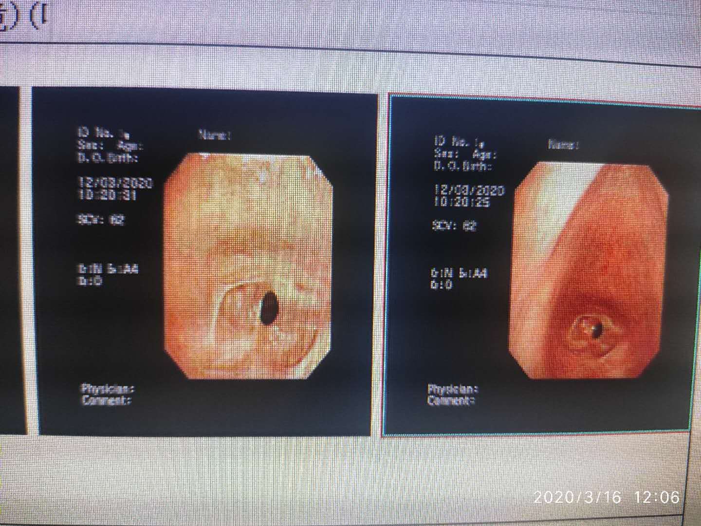 经支气管镜球囊扩张治疗气道狭窄,支气管镜球囊扩张操作视频
