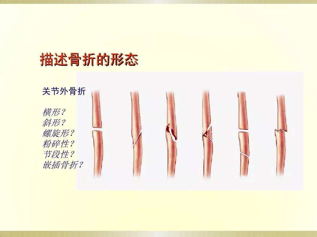 骨科x光片读片技巧,放射科骨科读片教程