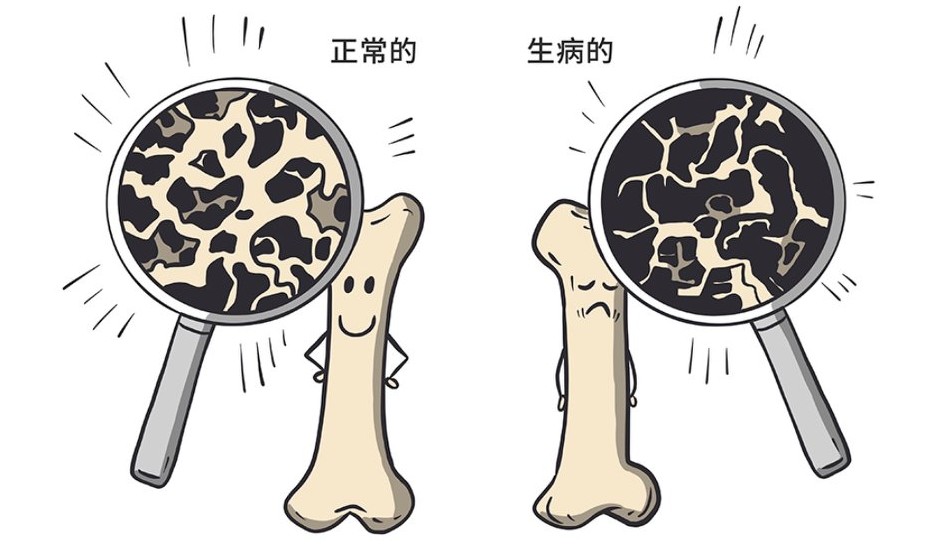 骨质疏松科学防治,骨质疏松的运动营养处方