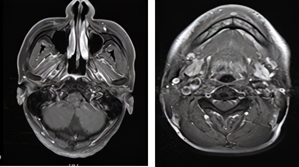 pd-1抑制剂适用的肿瘤类型,pd-1抑制剂能用于癌症晚期么