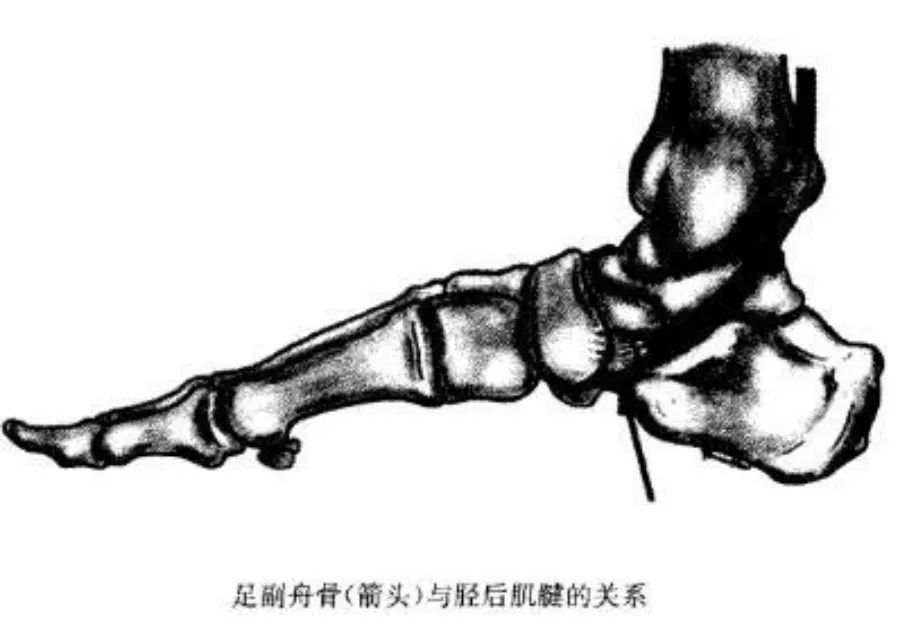 脚上多长了块骨头,腿关节多长了一块骨头