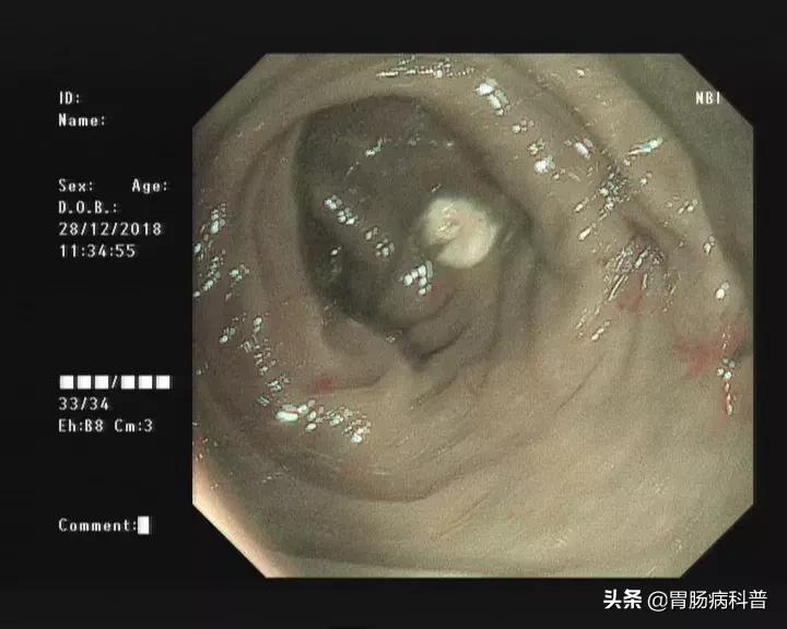 阑尾炎最新内镜微创手术,内镜下阑尾炎治疗术哪里可以做