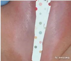 好奇，这个皮肤病居然会逐步阻挡羞羞之路