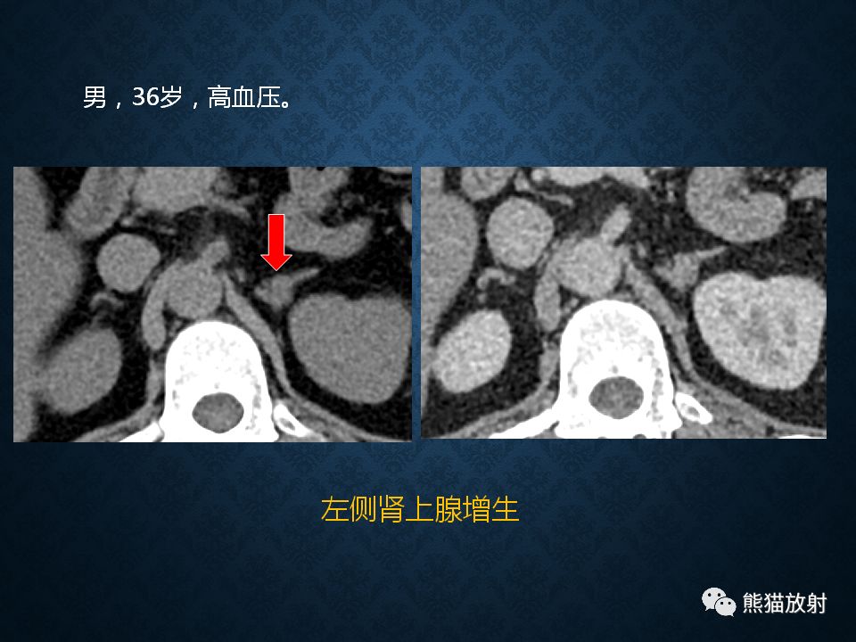 纵隔和肾上腺恶性肿瘤,纵隔性肿瘤位置图