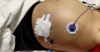 徐州医科大学附属医院布加综合征,布加综合征临床试验