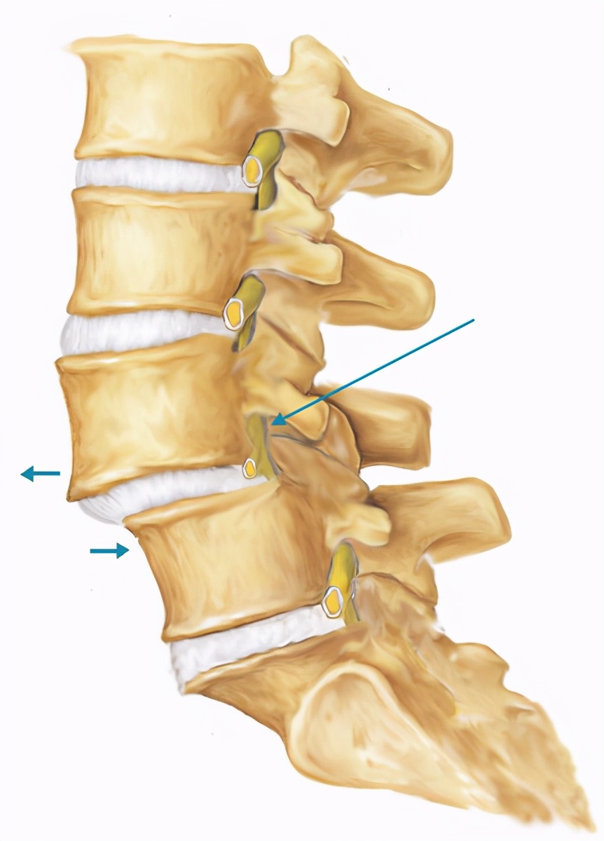 腰椎滑脱和腰椎滑移是一个概念吗,腰椎滑脱是不是骨折的意思