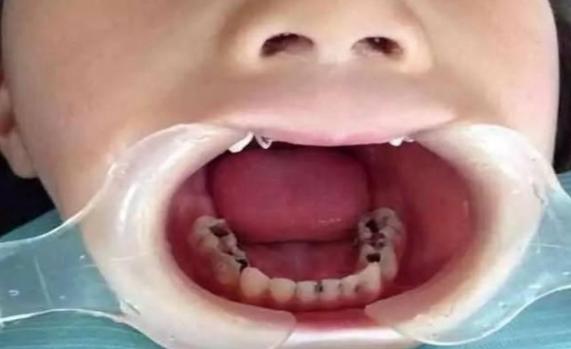 宝宝每天吃糖的危害,宝宝大量吃糖的危害