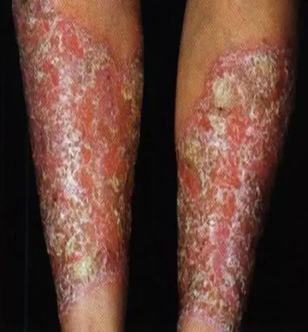 万古霉素用于mrsa的作用机制,万古霉素无效还有什么抗生素可用