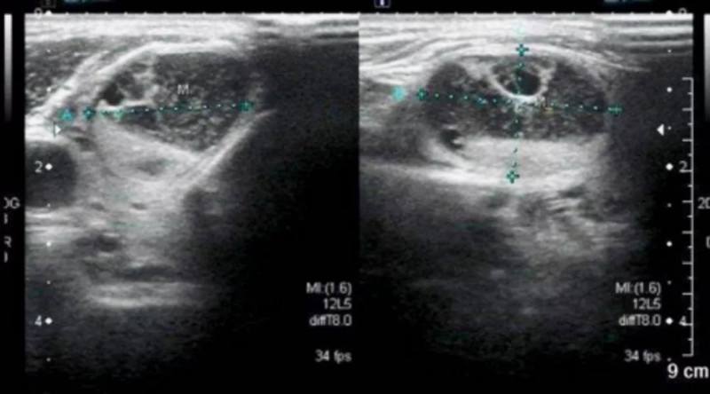 体检查到有甲状腺结节和乳腺结节,体检查出甲状腺结节还能买保险吗