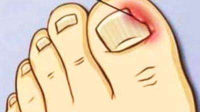 得甲沟炎最有效的处理方法是什么,甲沟炎怎么初期治疗才能彻底根除