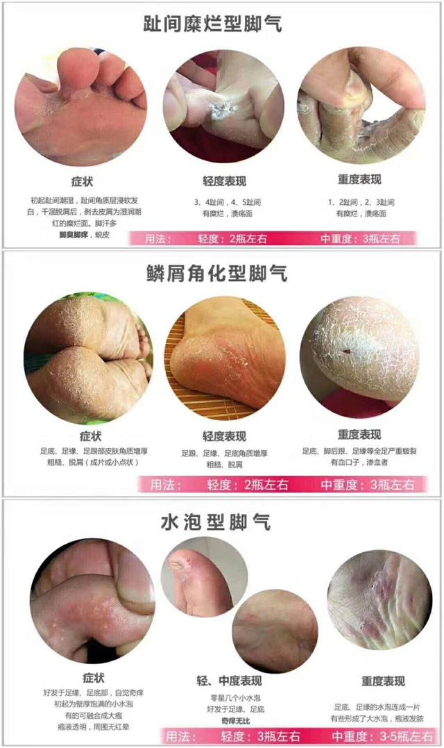 脚气发痒是什么原因引起的,脚气瘙痒严重该怎么办