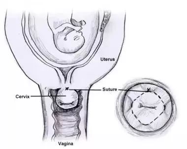 孕期宫颈环扎是怎么做,宫颈机能不全做环扎成功率有多高