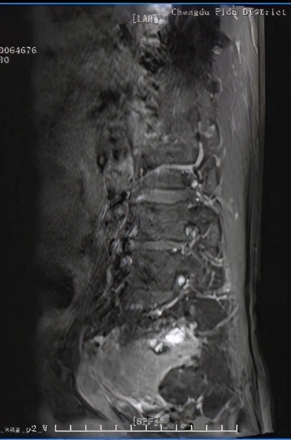罕见肿瘤中医治疗案例视频,罕见肿瘤中医治疗案例