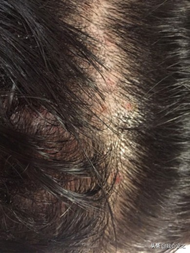 饱受毛囊炎的折磨,被真菌毛囊炎折磨