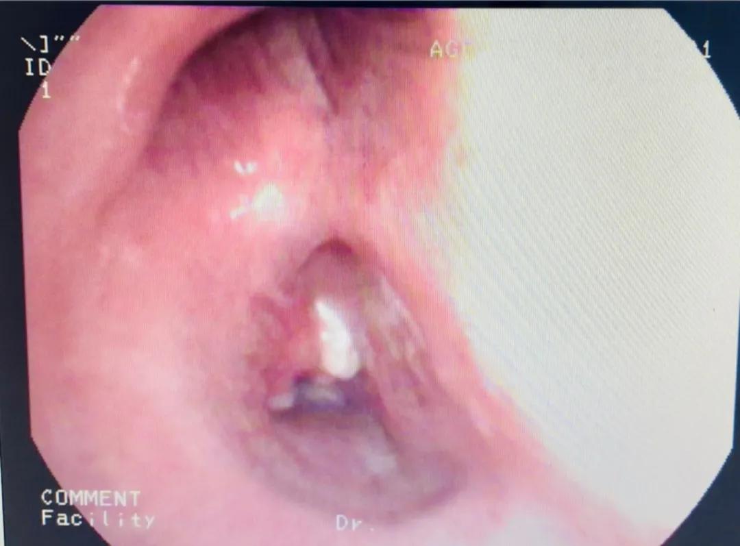 硬质支气管镜是什么手术,超导可视支气管镜介入治疗