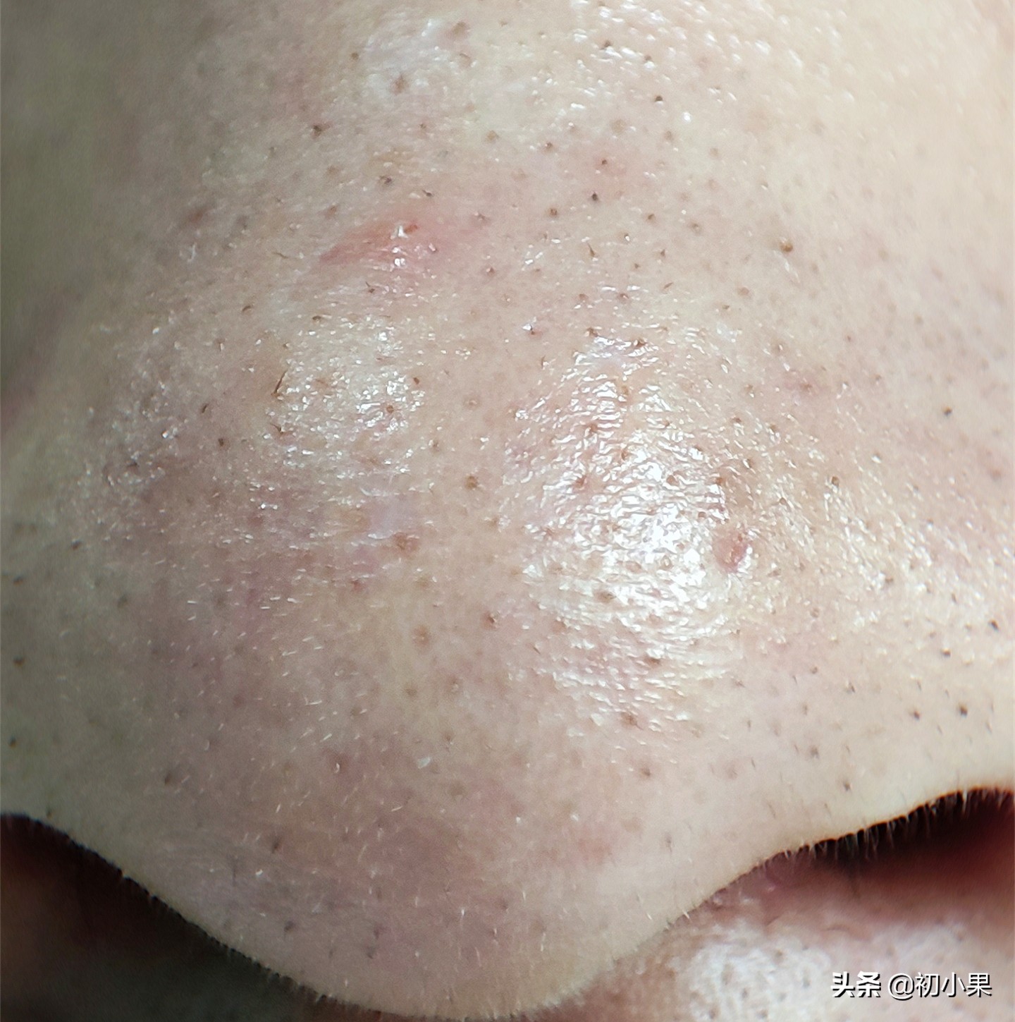 鼻子上的黑头怎么去除,鼻子上的黑头怎么去除儿童