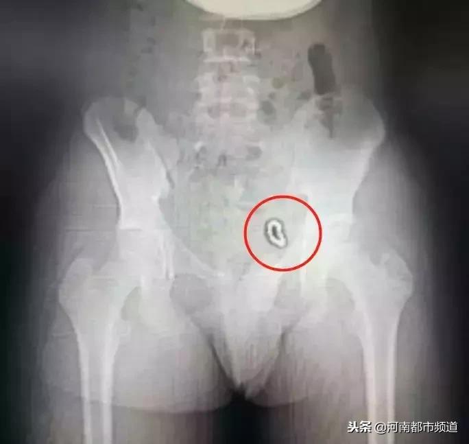 10余岁男孩往“小鸡鸡”塞了14颗磁球，一年半后……