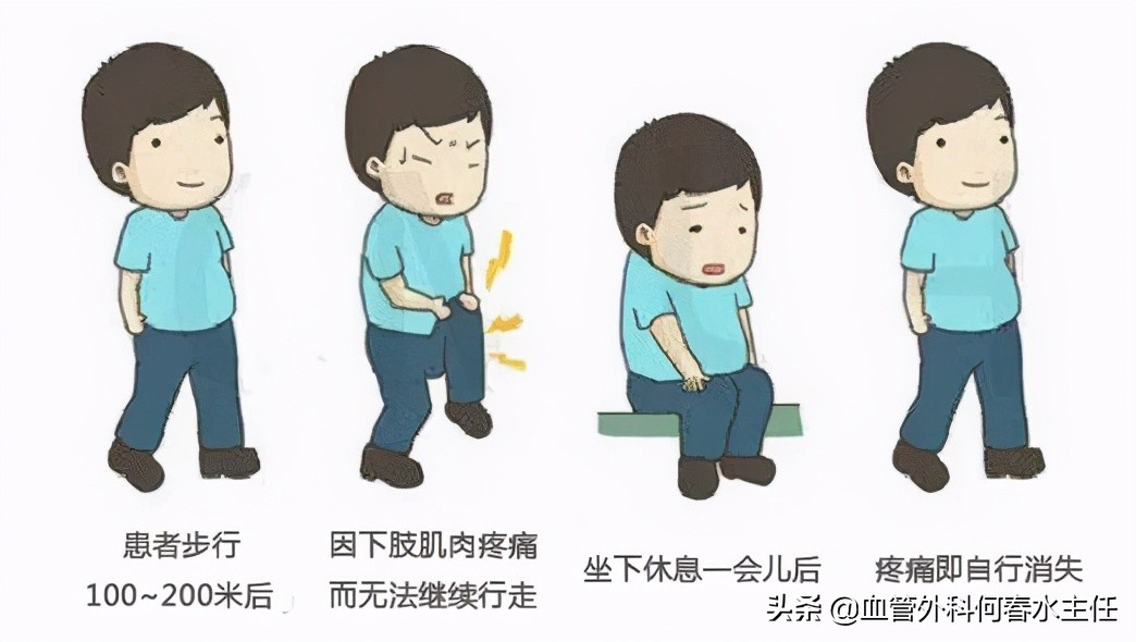 静脉曲张腿脚不好？治疗有“门路”