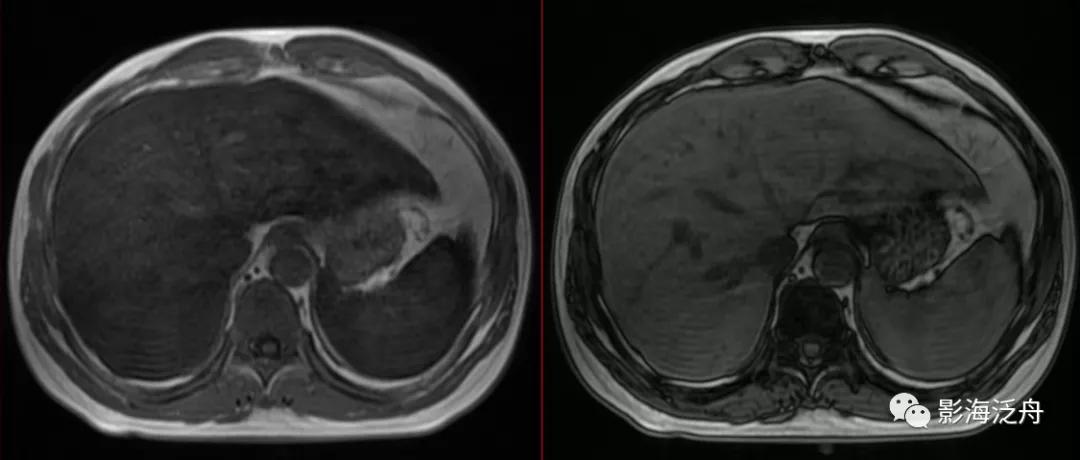 肝脏弥漫性病变严重吗,肝脏弥漫性的病变的症状