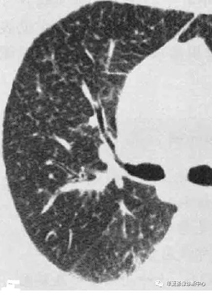肺部代谢周期是多少天,肺部高代谢病变