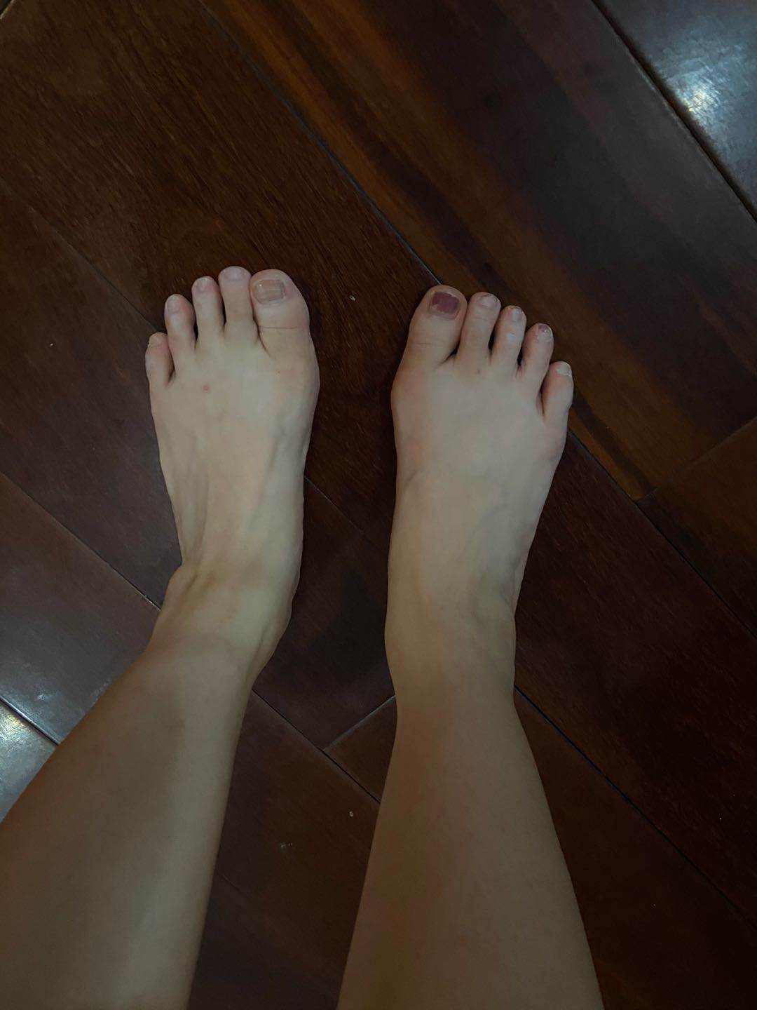 减肥后脚变大了,减肥后脚也会变小吗