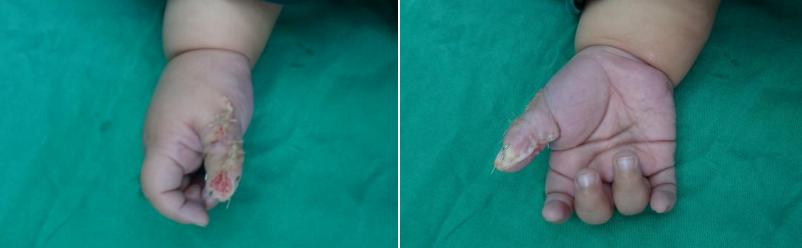 婴儿长六指可做手术吗,新生儿六指手术哪个医院最好