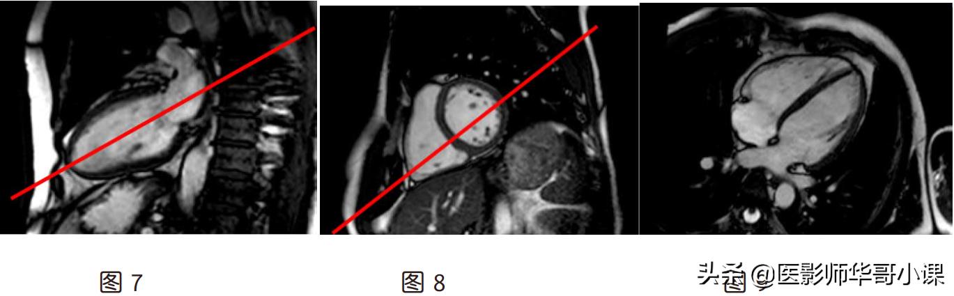 心脏mr增强扫描讲解,磁共振心脏扫描标准切面