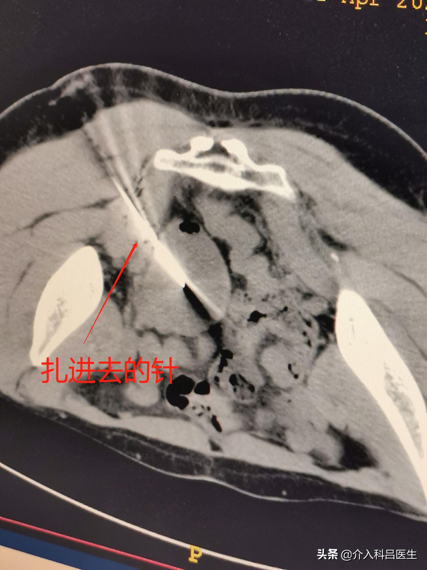 河南卵巢囊肿介入治疗哪家好,一根针治疗卵巢囊肿过程
