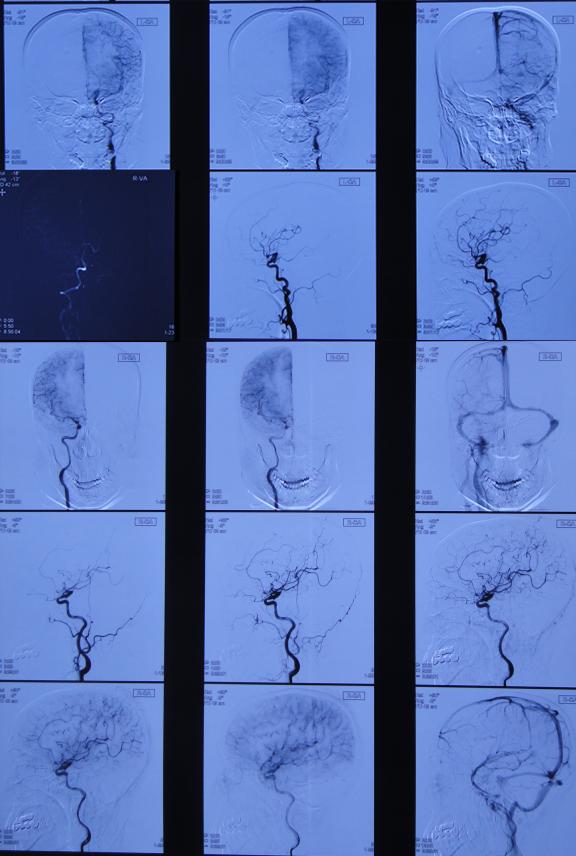 脑出血后脑积水会造成意识不清吗,脑出血后脑积水发高烧危险期多久