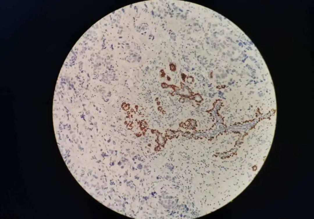 病理报告为什么这么慢,手术后病理报告准确率高吗