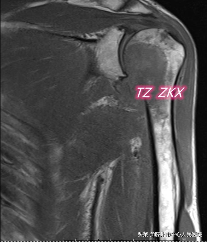 ct引导下椎间盘微创消融术辐射大,CT引导下腰椎射频消融术辐射大吗