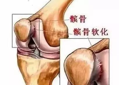 走路经常打软脚是怎么回事,走路猛然腿一软怎么回事