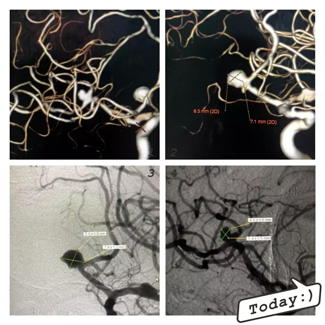 动脉瘤弹簧圈栓塞术护理问题,介入脑动脉瘤填塞弹簧圈
