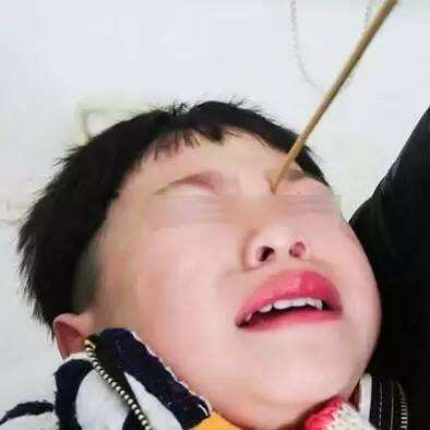 小孩被石灰粉误伤,小朋友被石灰烧伤了怎么处理