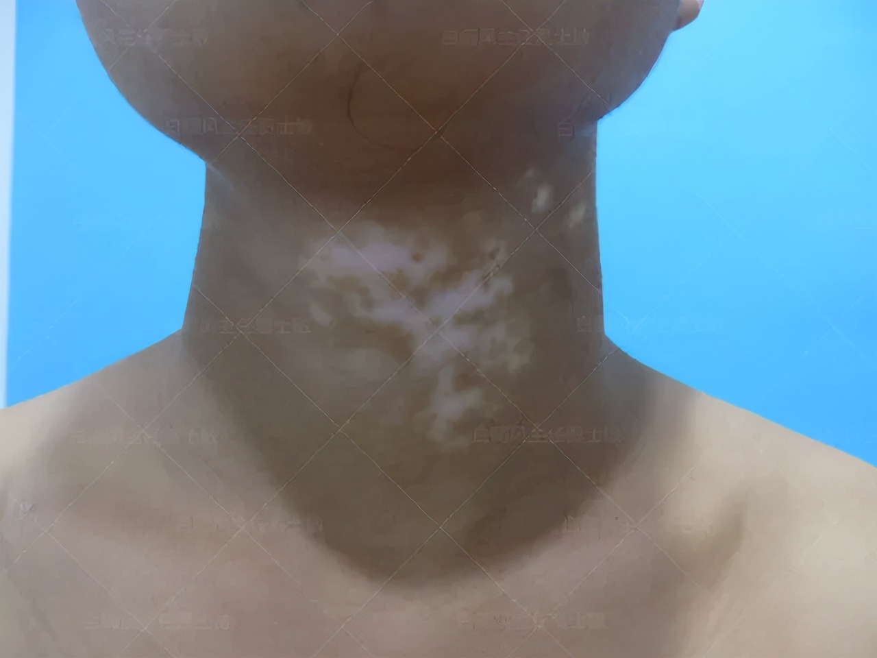 18岁男孩高考备战,18岁男孩白斑