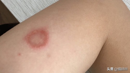 猫癣最全的药物治疗方法,如何快速的治愈猫癣