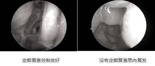 鼻窦炎鼻息肉手术后要怎么复查,鼻窦炎鼻息肉术后二十天复查痛吗